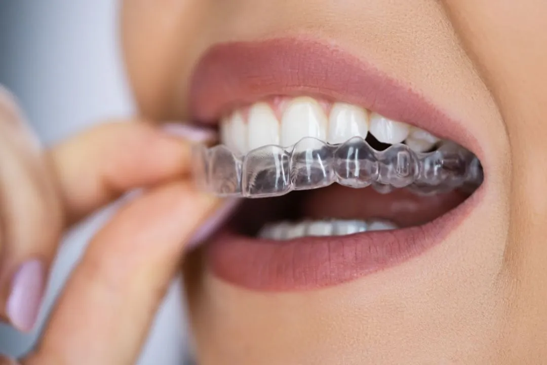 Braces and Aligners