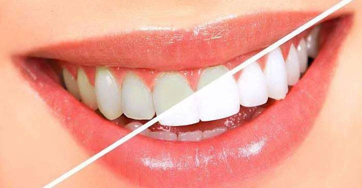 Teeth Whitening
