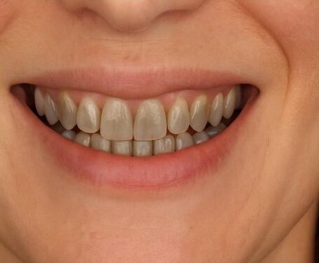 Before treatment