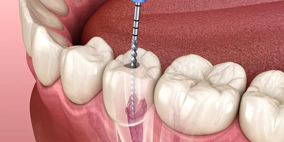 Root Canal Treatment